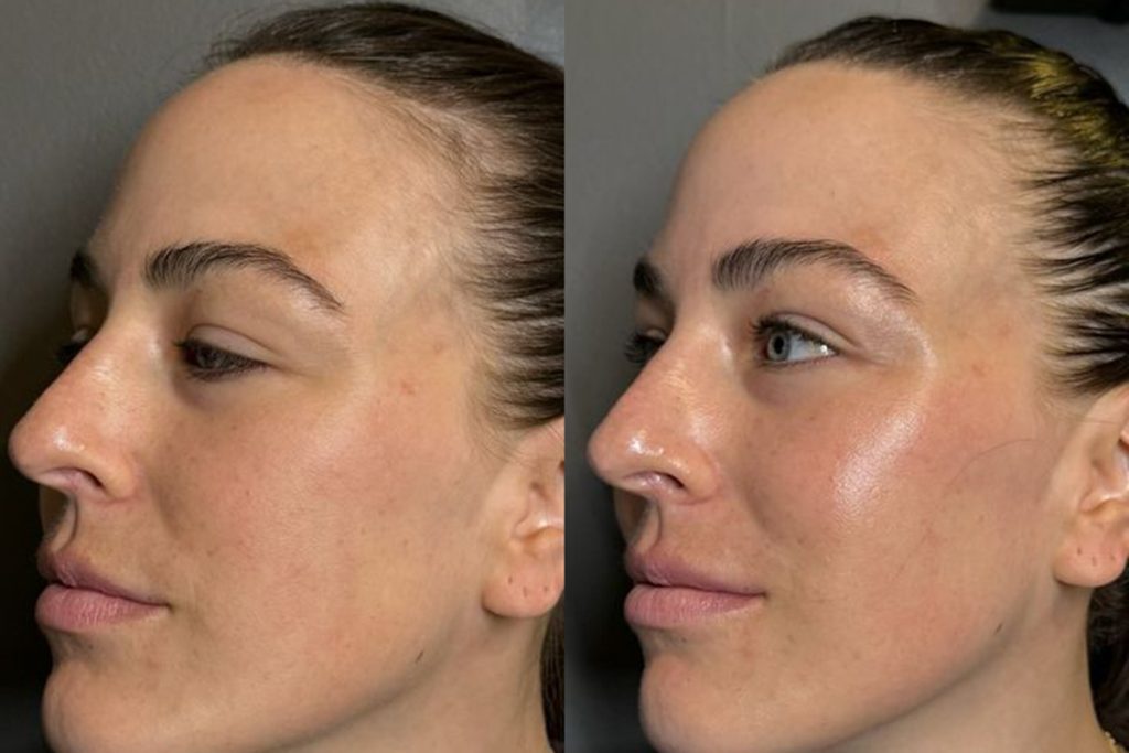 Repechage Facial Result